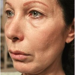Thermage Before & After Patient #1587